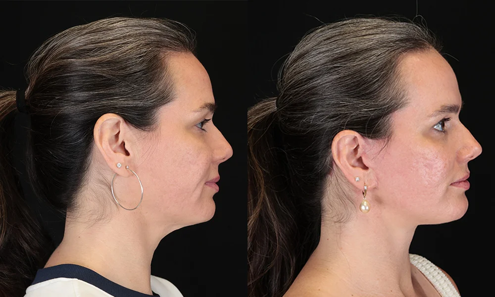 Real patient results in New York, NY Performed by Sameer Halani, MD