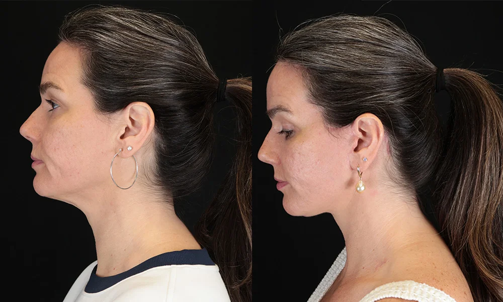 Real patient results in New York, NY Performed by Sameer Halani, MD