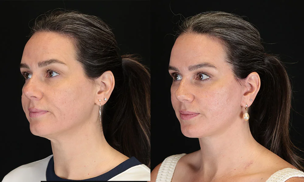 Real patient results in New York, NY Performed by Sameer Halani, MD