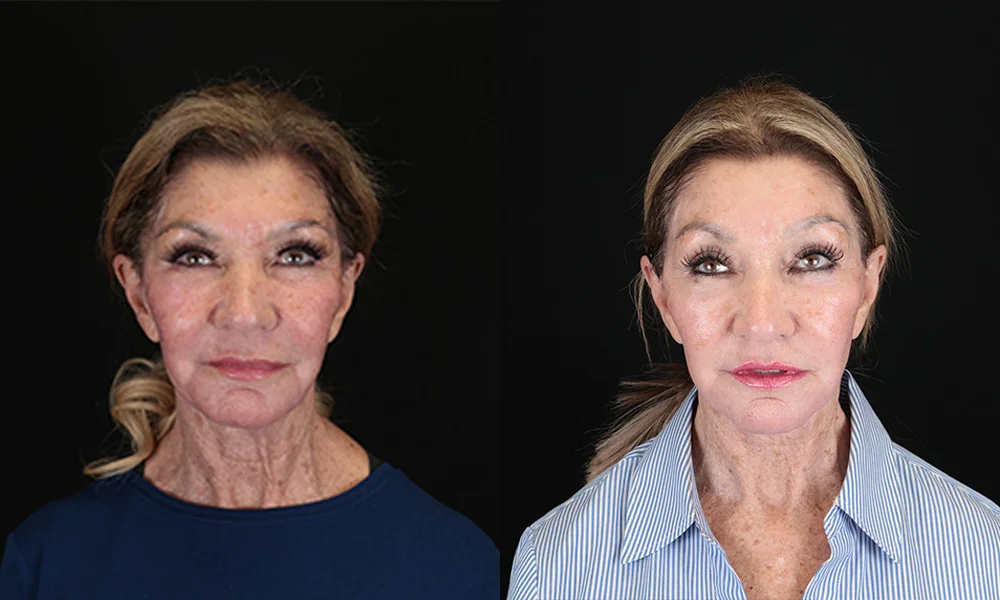 Real patient results in New York, NY Performed by Sameer Halani, MD