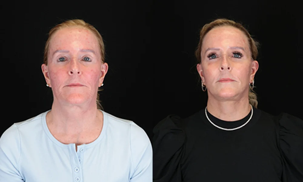 Real patient results in New York, NY Performed by Sameer Halani, MD