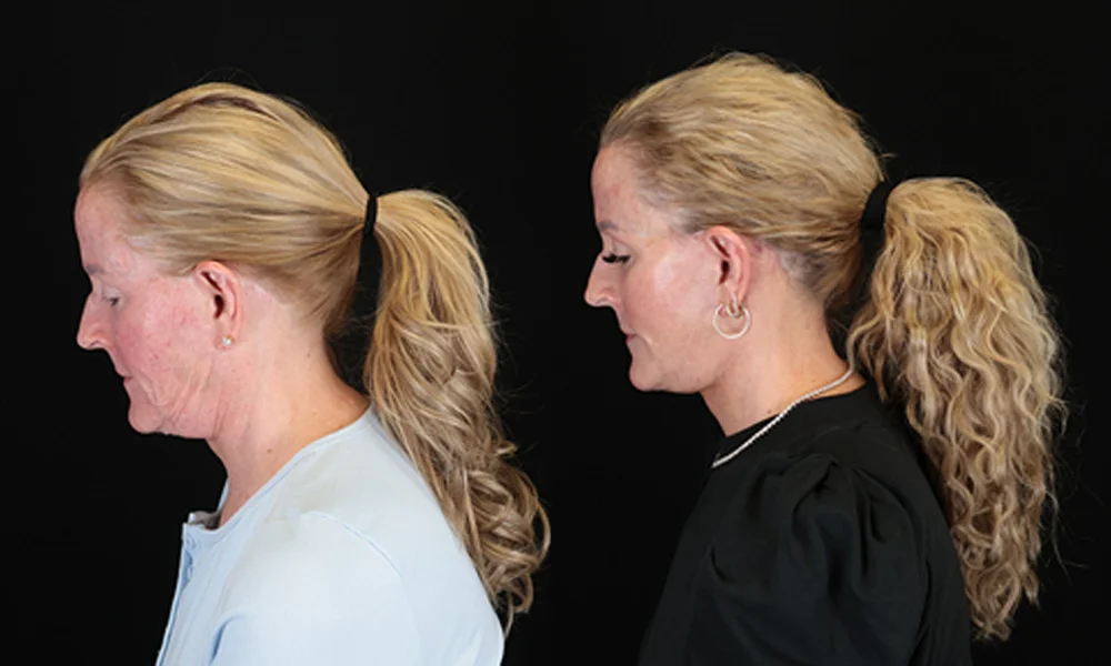 Real patient results in New York, NY Performed by Sameer Halani, MD