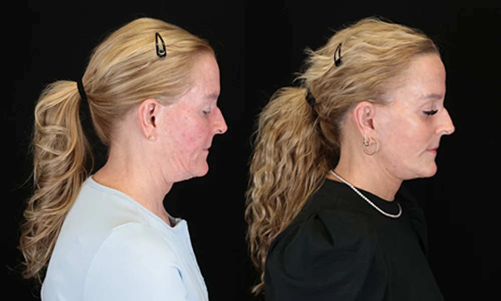 Real patient results in New York, NY Performed by Sameer Halani, MD