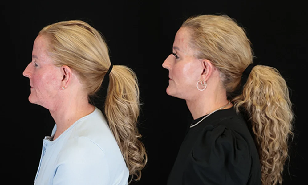 Real patient results in New York, NY Performed by Sameer Halani, MD