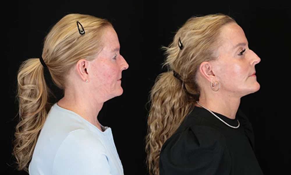 Real patient results in New York, NY Performed by Sameer Halani, MD