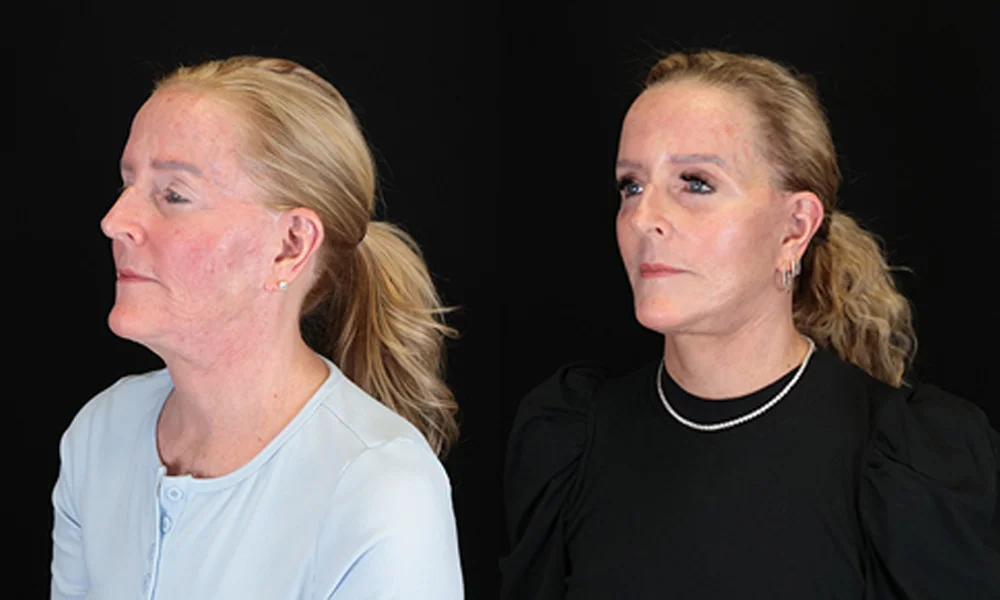 Real patient results in New York, NY Performed by Sameer Halani, MD