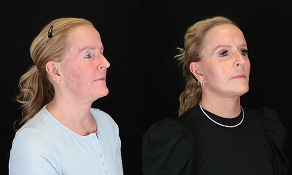 Real patient results in New York, NY Performed by Sameer Halani, MD