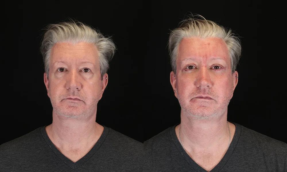 Real patient results in New York, NY Performed by Sameer Halani, MD