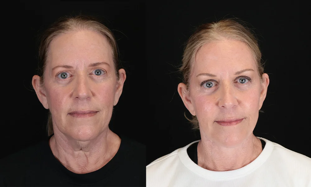 Real patient results in New York, NY Performed by Sameer Halani, MD