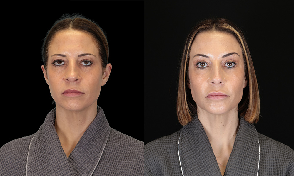 Real patient results in New York, NY Performed by Sameer Halani, MD