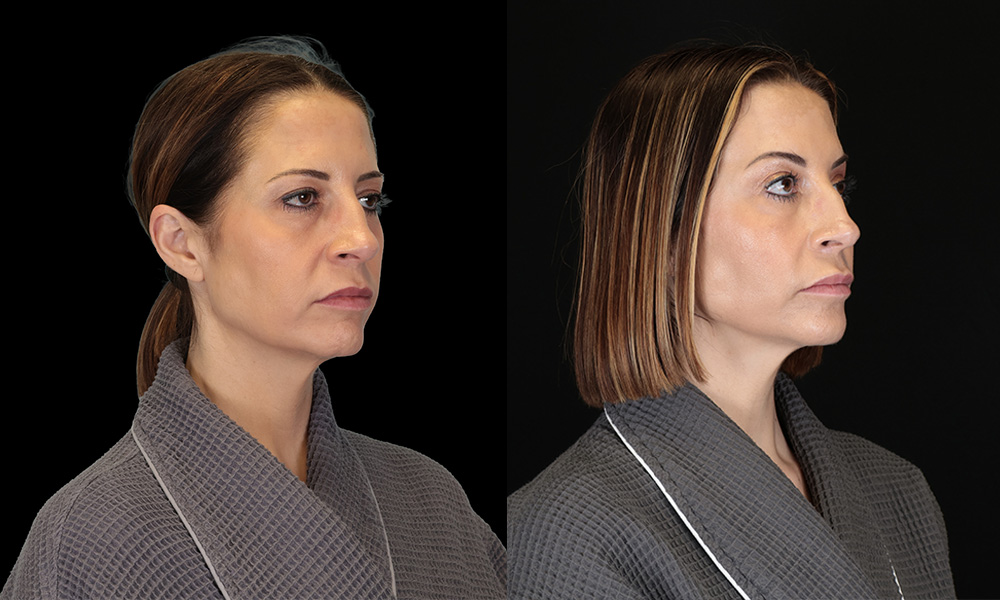 Real patient results in New York, NY Performed by Sameer Halani, MD