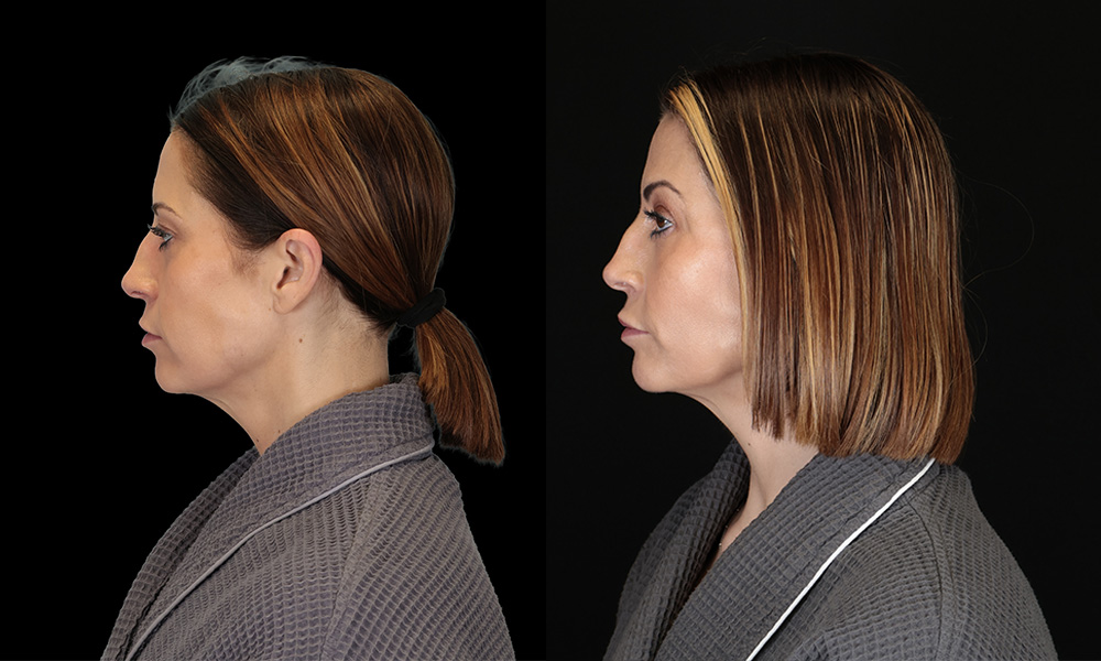 Real patient results in New York, NY Performed by Sameer Halani, MD