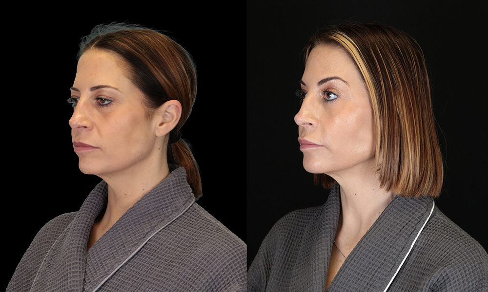 Real patient results in New York, NY Performed by Sameer Halani, MD