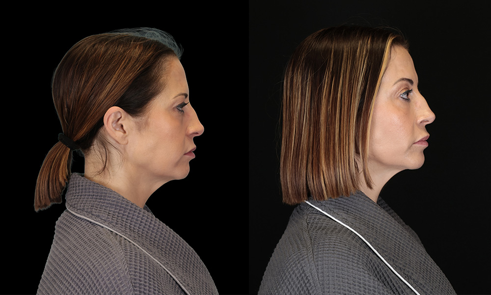 Real patient results in New York, NY Performed by Sameer Halani, MD
