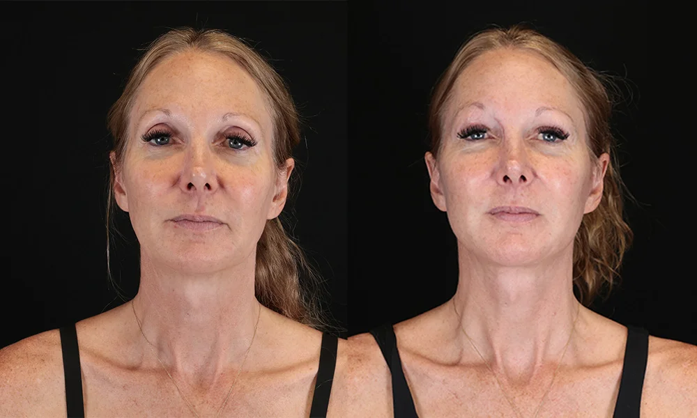 Real patient results in New York, NY Performed by Sameer Halani, MD
