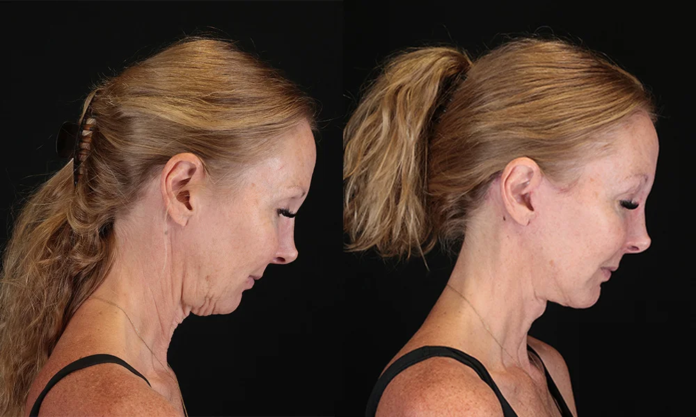 Real patient results in New York, NY Performed by Sameer Halani, MD