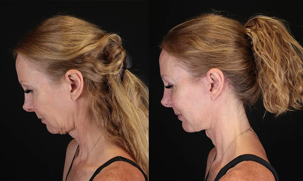 Real patient results in New York, NY Performed by Sameer Halani, MD