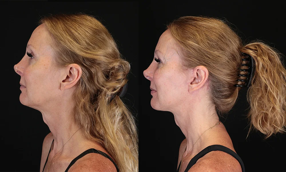 Real patient results in New York, NY Performed by Sameer Halani, MD