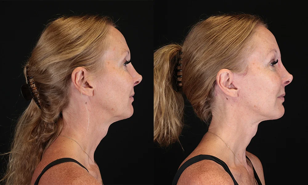 Real patient results in New York, NY Performed by Sameer Halani, MD