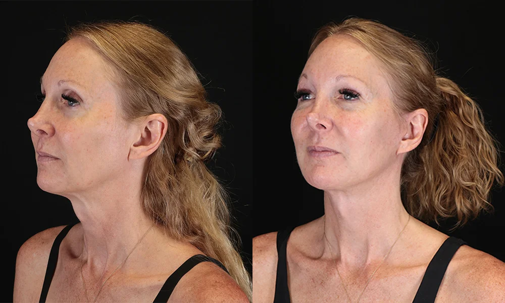 Real patient results in New York, NY Performed by Sameer Halani, MD