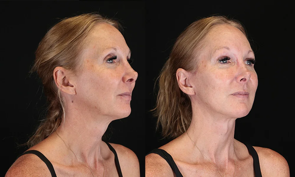Real patient results in New York, NY Performed by Sameer Halani, MD