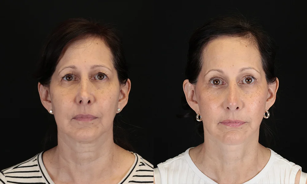 Real patient results in New York, NY Performed by Sameer Halani, MD