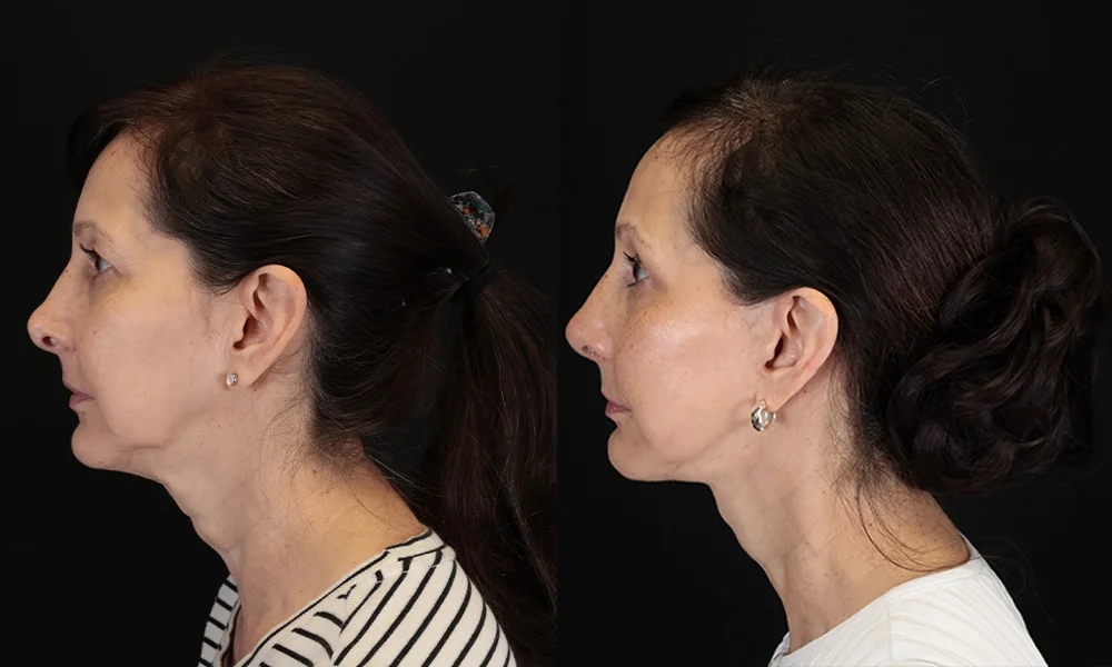 Real patient results in New York, NY Performed by Sameer Halani, MD