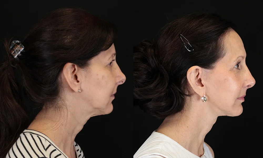 Real patient results in New York, NY Performed by Sameer Halani, MD