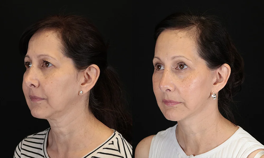 Real patient results in New York, NY Performed by Sameer Halani, MD