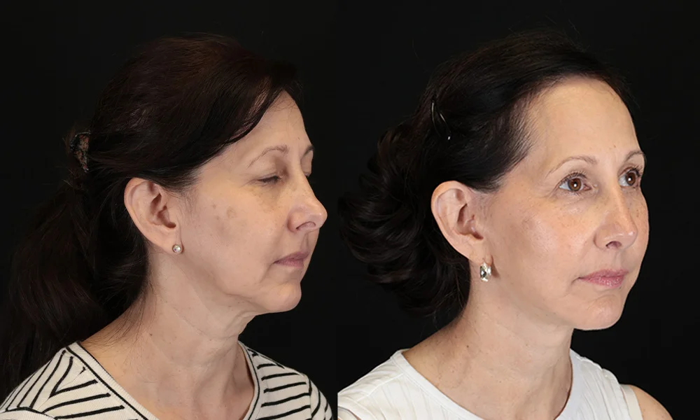 Real patient results in New York, NY Performed by Sameer Halani, MD