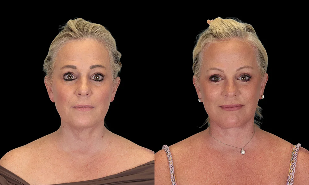 Real patient results in New York, NY Performed by Sameer Halani, MD