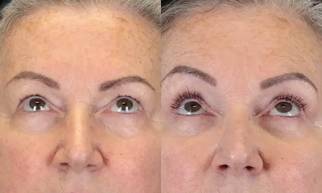 Real patient results in New York, NY Performed by Sameer Halani, MD