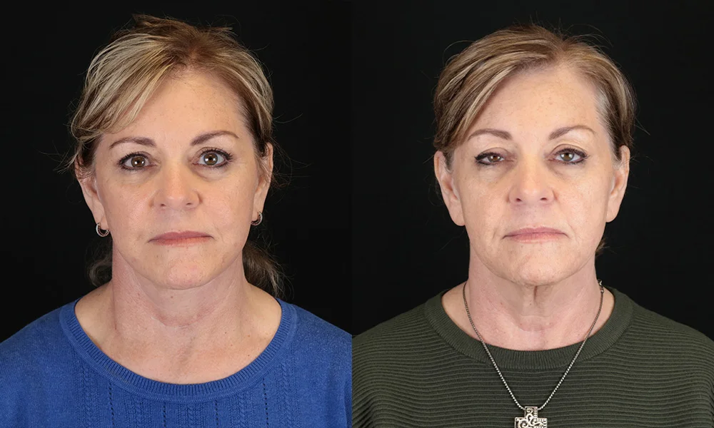 facelift 1