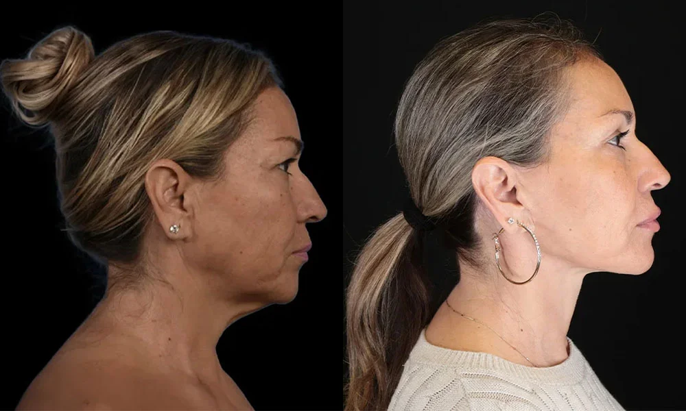 facelift 2