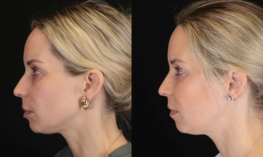 Real patient results in New York, NY Performed by Sameer Halani, MD