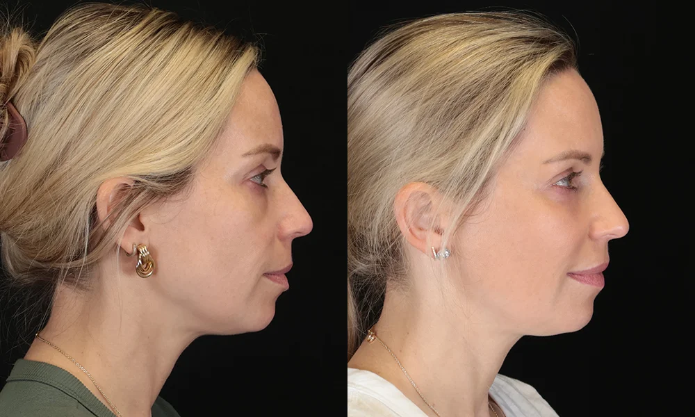 Real patient results in New York, NY Performed by Sameer Halani, MD