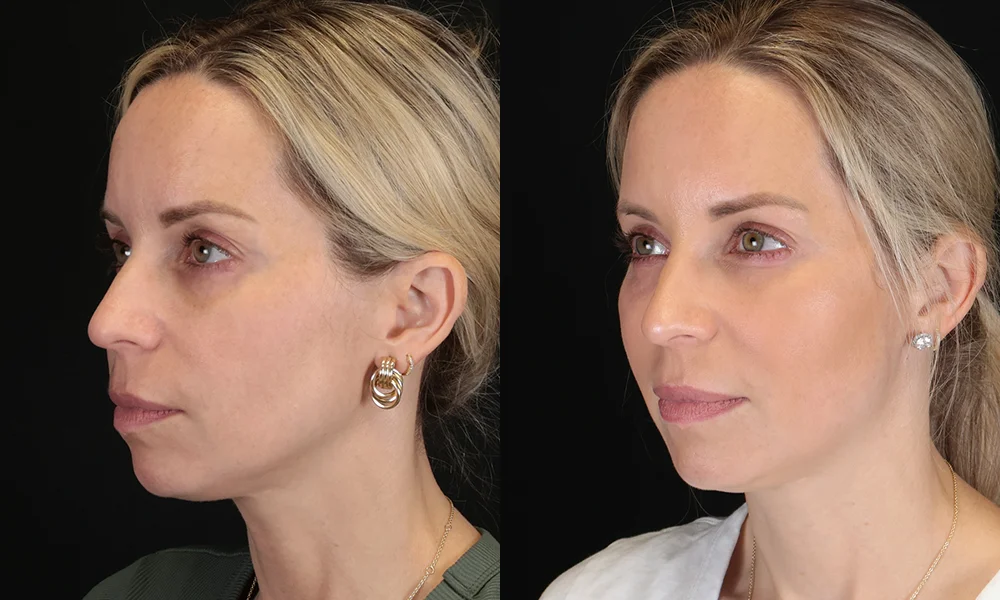 Real patient results in New York, NY Performed by Sameer Halani, MD