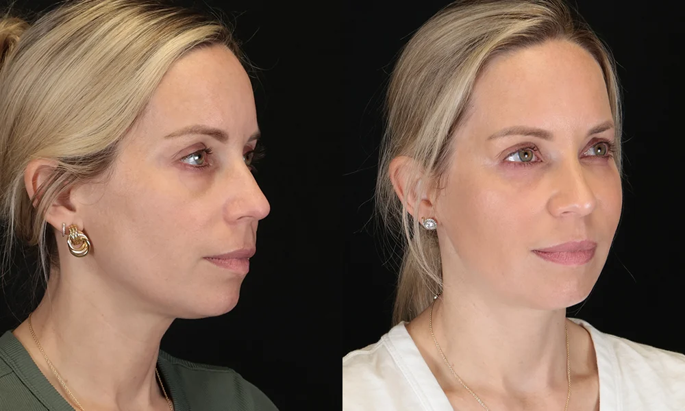 Real patient results in New York, NY Performed by Sameer Halani, MD