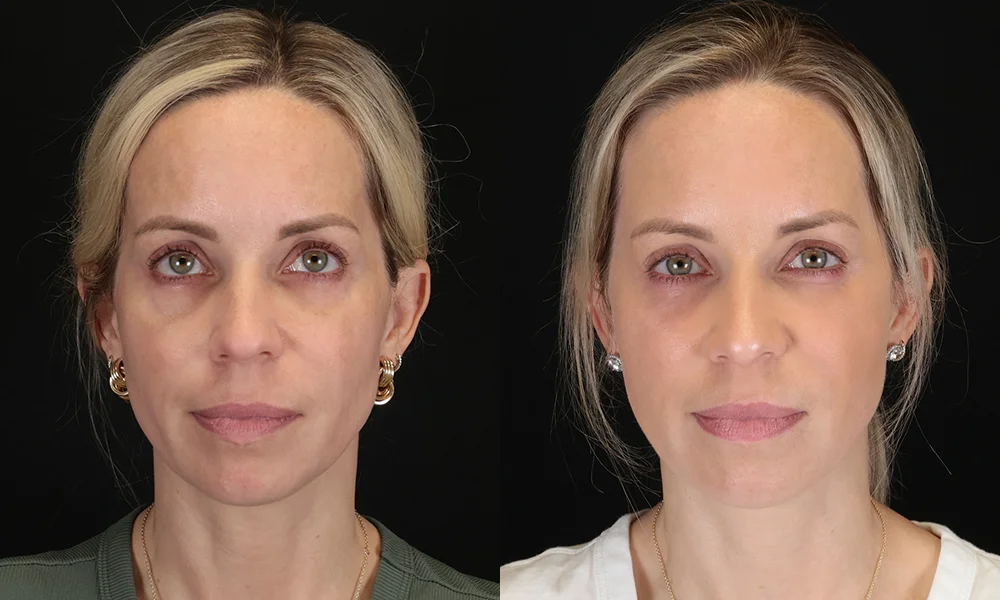 Real patient results in New York, NY Performed by Sameer Halani, MD