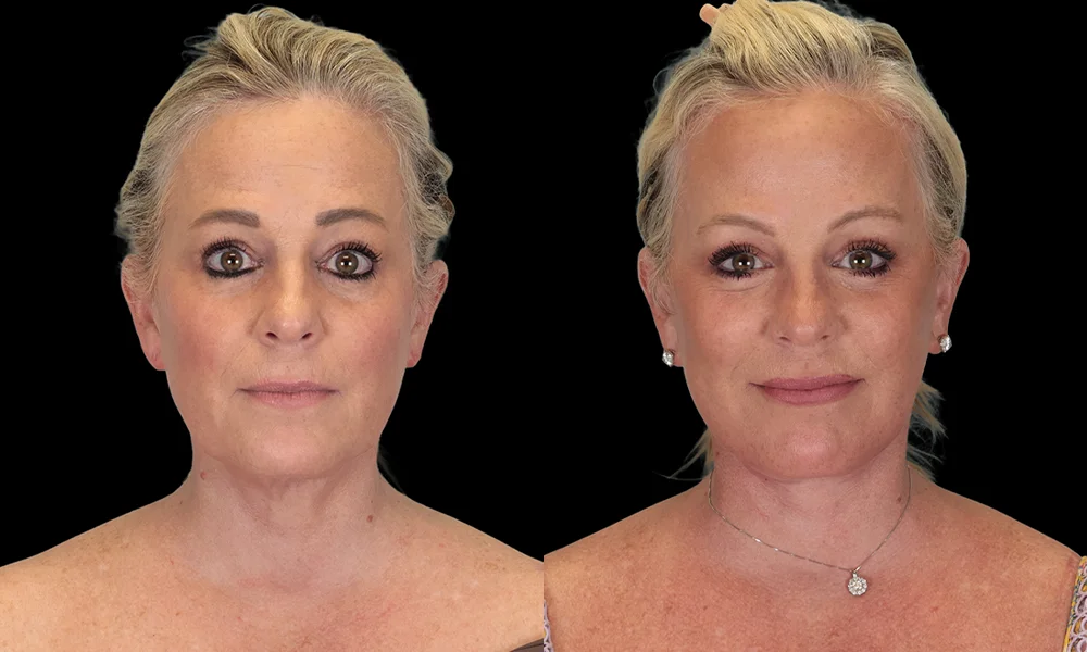 Real patient results in New York, NY Performed by Sameer Halani, MD