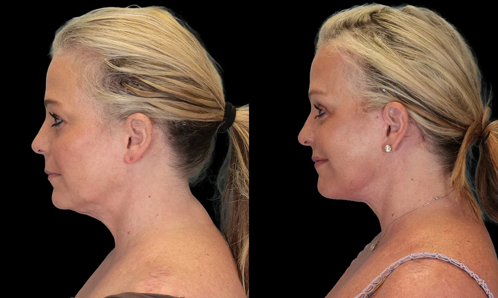 Real patient results in New York, NY Performed by Sameer Halani, MD