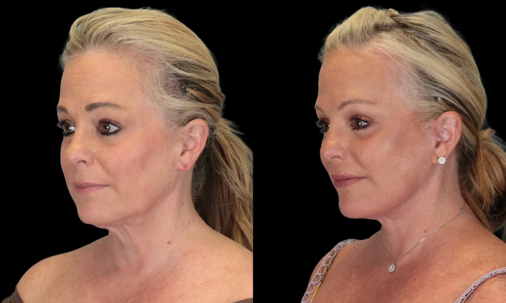 Real patient results in New York, NY Performed by Sameer Halani, MD