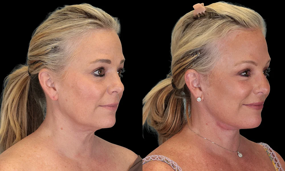 Real patient results in New York, NY Performed by Sameer Halani, MD