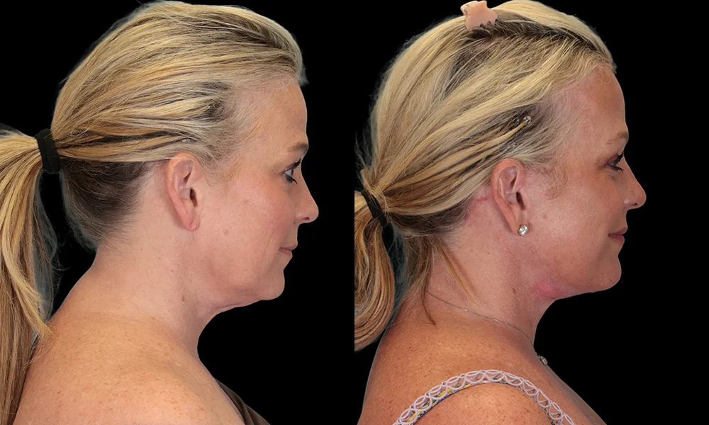 Real patient results in New York, NY Performed by Sameer Halani, MD