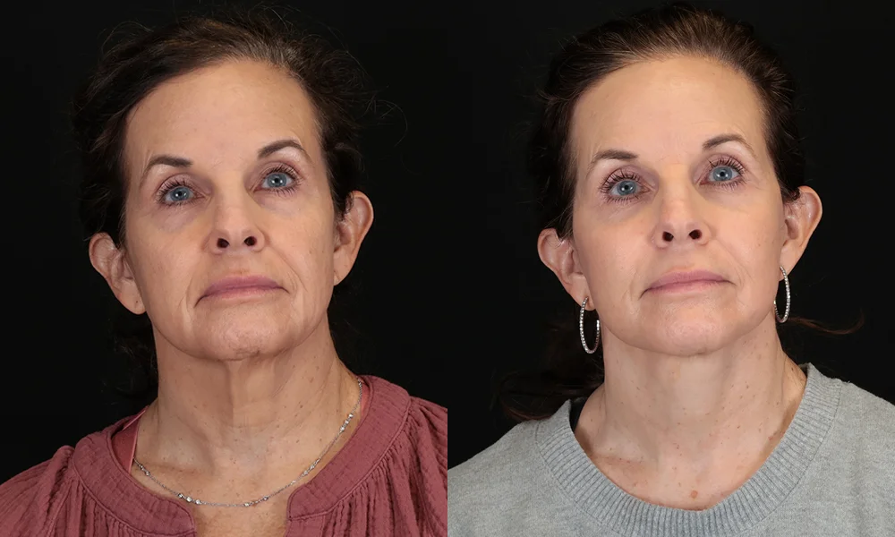 Real patient results in New York, NY Performed by Sameer Halani, MD