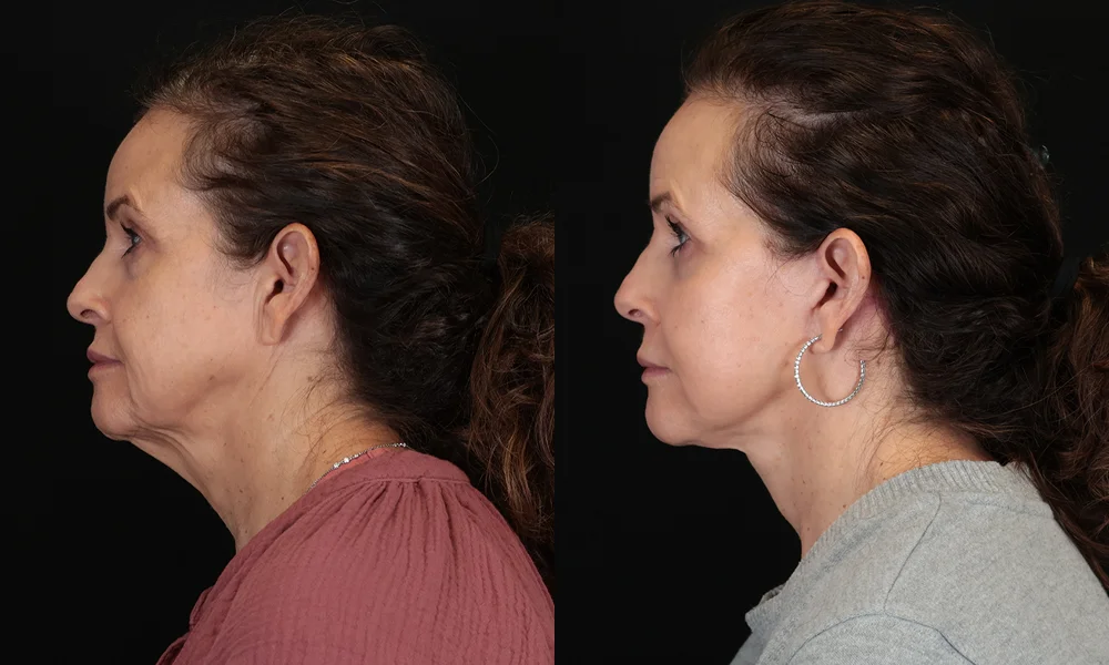 Real patient results in New York, NY Performed by Sameer Halani, MD
