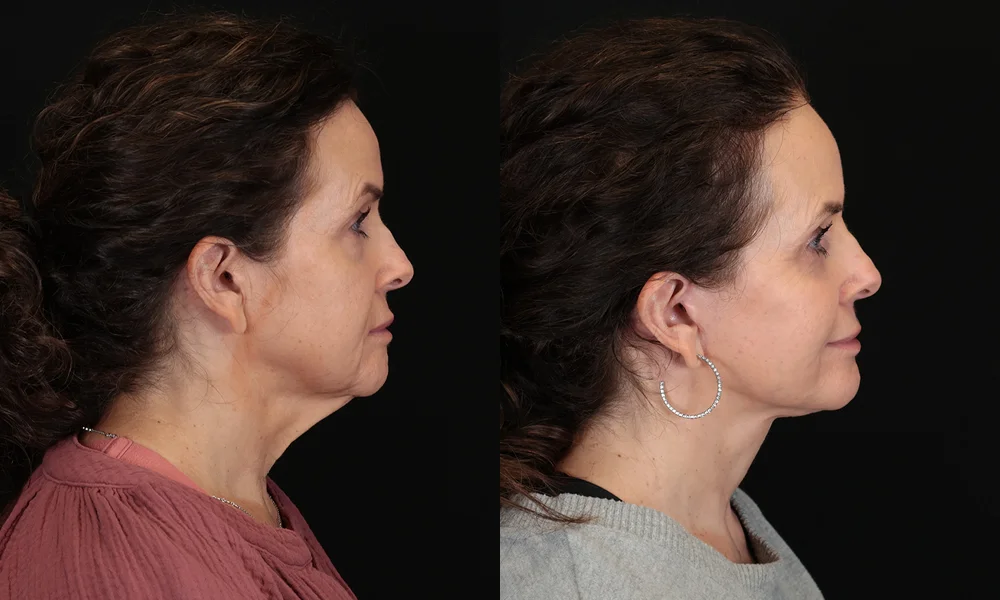 Real patient results in New York, NY Performed by Sameer Halani, MD
