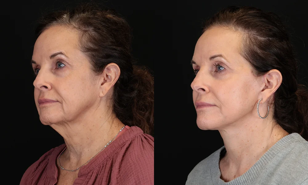Real patient results in New York, NY Performed by Sameer Halani, MD