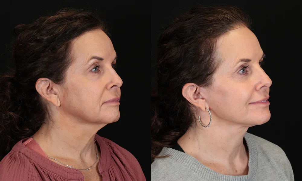 Real patient results in New York, NY Performed by Sameer Halani, MD