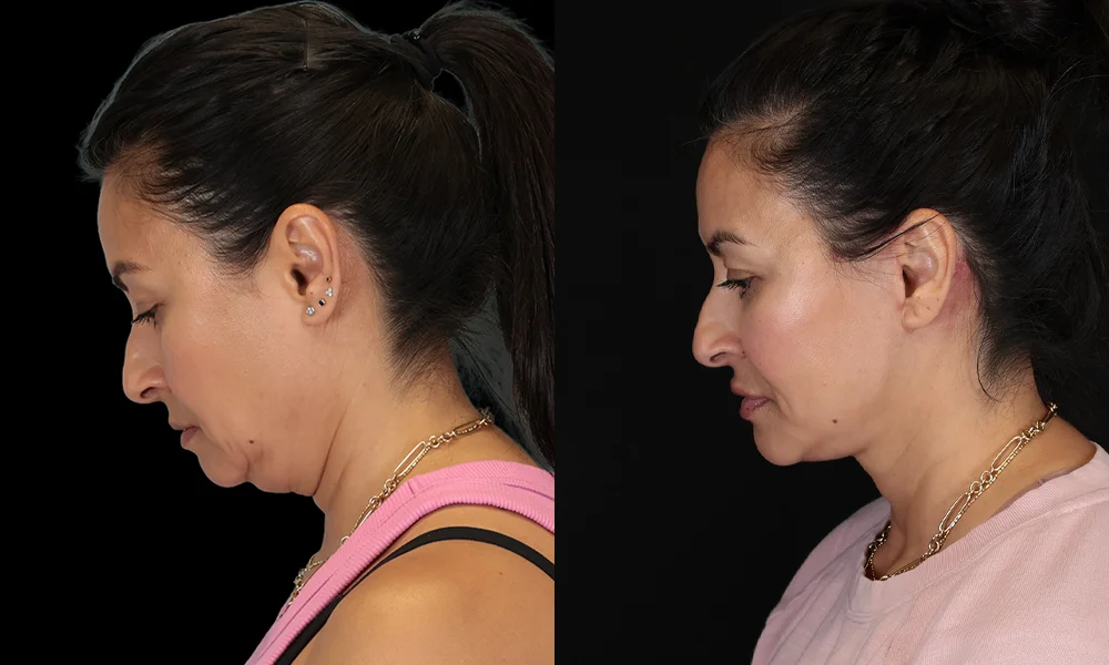 Real patient results in New York, NY Performed by Sameer Halani, MD